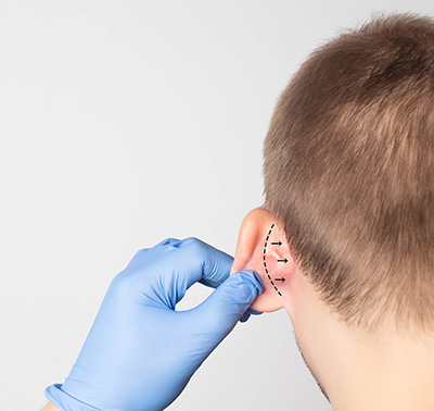 Ear Pinning Surgery Twin Cities