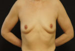 Breast Augmentation