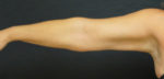 Liposuction Results Twin Cities