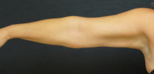 Liposuction Case 4421 After Photo Liposuction