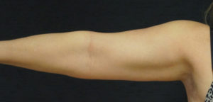 Liposuction Case 4421 Before Photo Liposuction