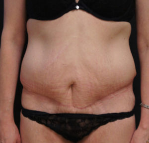 Panniculectomy without Abdominoplasty