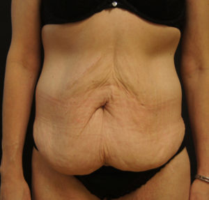 Panniculectomy without Abdominoplasty