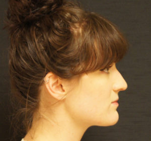 Rhinoplasty