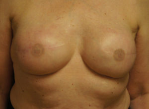 Breast Reconstruction with Nipple Tattooing Case 4433 After Photo Breast Reconstruction with Nipple Tattooing