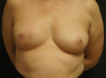 Breast Reconstruction with Nipple Tattooing
