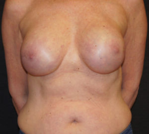 Breast Reconstruction