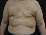 Breast Reconstruction with Fat Grafting