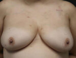 Breast Reconstruction
