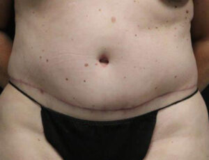 Tummy Tuck