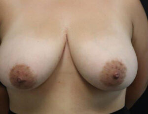 Breast Reduction Case 5386 Before Photo Breast Reduction