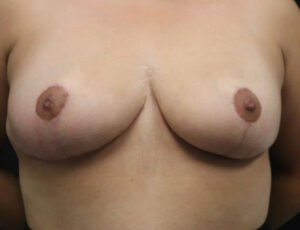 Breast Reduction Case 5386 After Photo Breast Reduction
