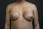 Breast Augmentation