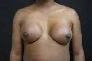Breast Augmentation