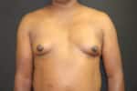 Breast Augmentation