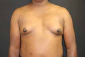 Breast Augmentation