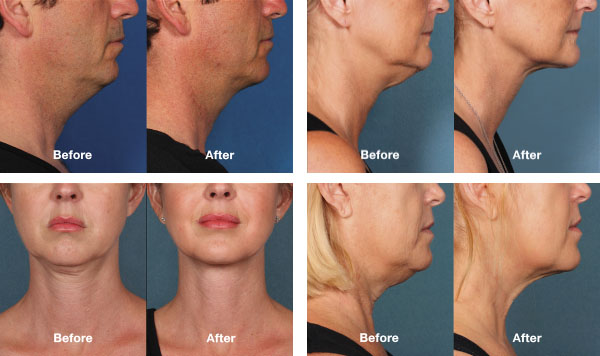 Kybella Before & After Photos