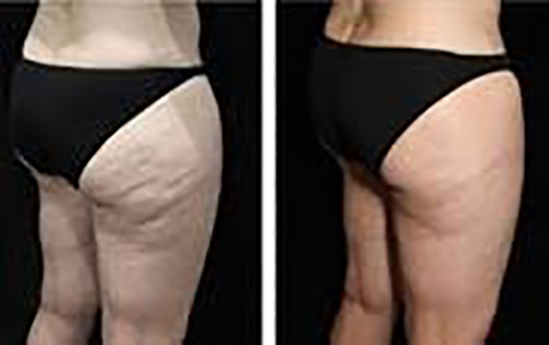 cellulite results