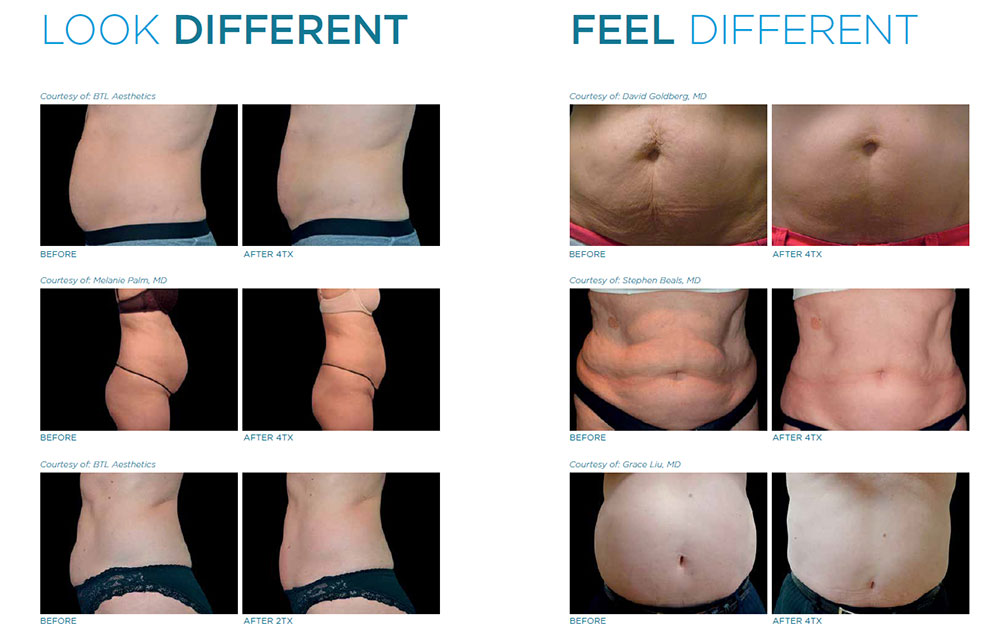 Vanquish Twin Cities, Non-Surgical Body Contouring St. Paul