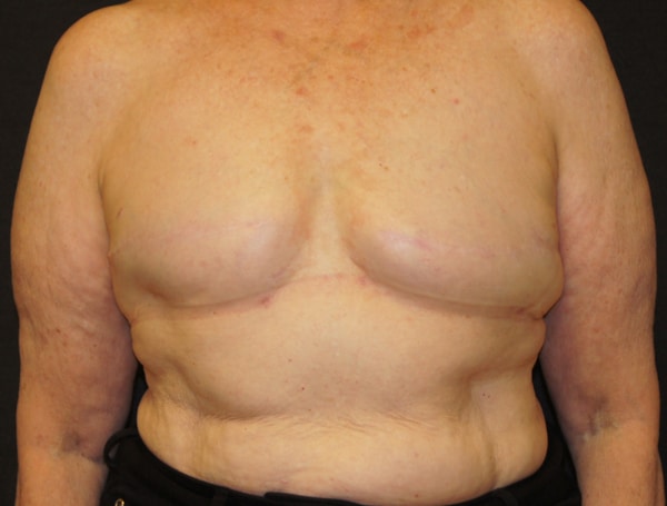 Breast Reconstruction with Fat Grafting After Photo Breast Reconstruction with Fat Grafting After Photo