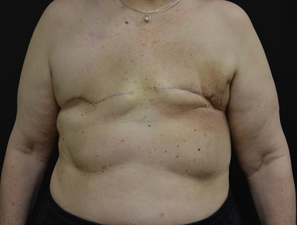Breast Reconstruction with Fat Grafting Before Photo Breast Reconstruction with Fat Grafting Before Photo