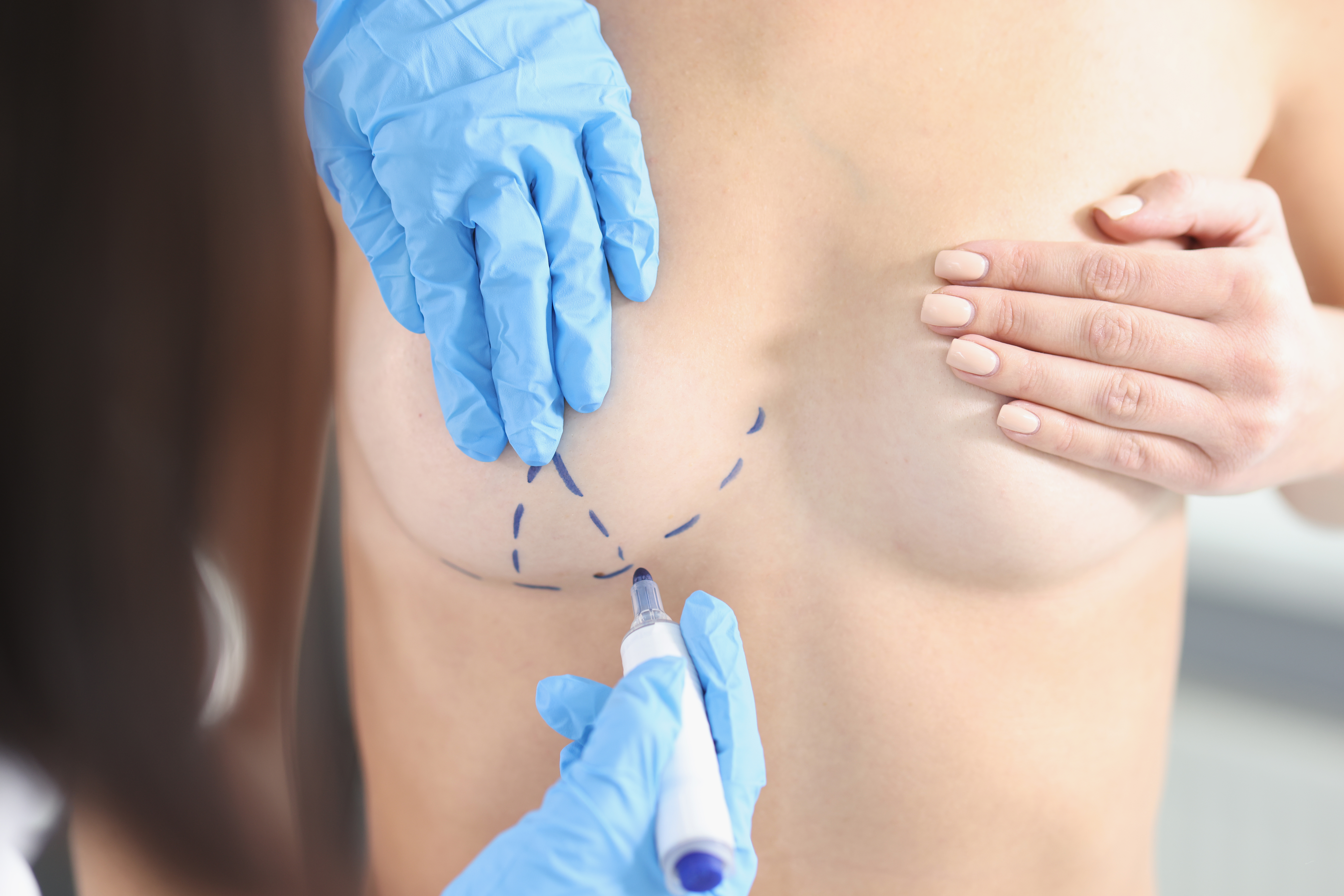 Hands draw with a marker on the female breast - Breast Reduction