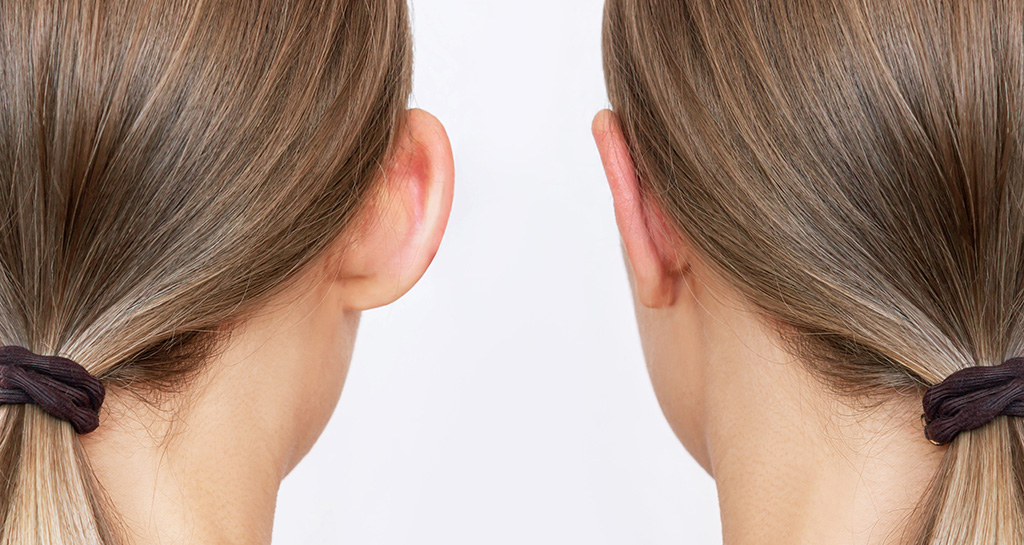 Ear Pinning Surgery Otoplasty Twin Cities