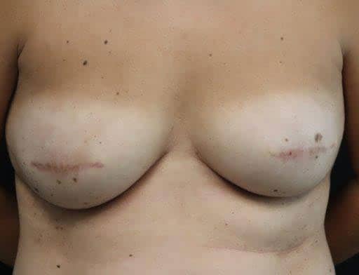 Breast Reconstruction After Photo Breast Reconstruction After Photo