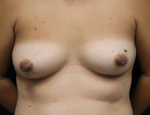 Breast Reconstruction Before and After Photo Breast Reconstruction Before Photo